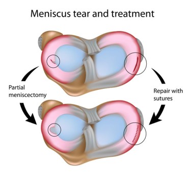 Meniscectomy by OrangeCountySurgeons.org - 2